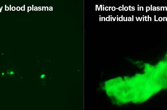 Mikroskopische Aufnahme mit Leuchtmitteln markierter Blutkörperchen in einer Gegenüberstellung von gesunden Menschen und Long Covid Patienten. Letztere sind großflächig grün leuchtend, erstere kleine grüne Punkte.