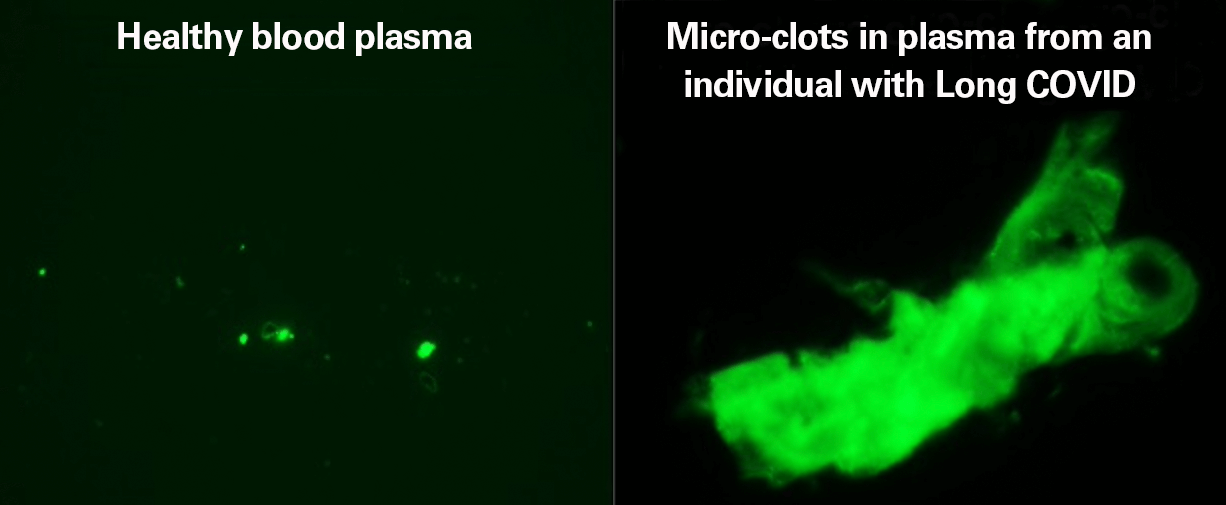 Microscopic image of blood cells marked with illuminants in a comparison of healthy people and Long Covid patients. The latter are glowing green over a large area, the former are small green dots.